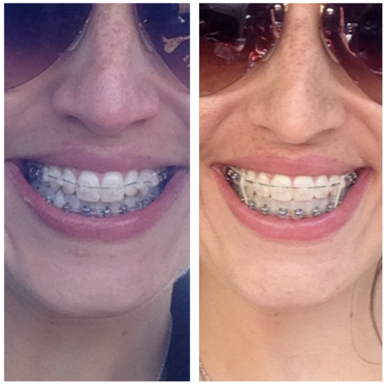 Six Months in Braces! | Kaplan Orthodontics