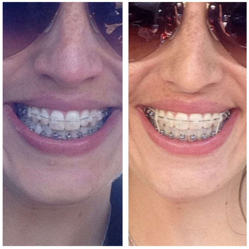 6 Months in braces!