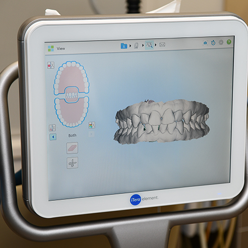 Metal Braces