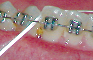 food caught between teeth